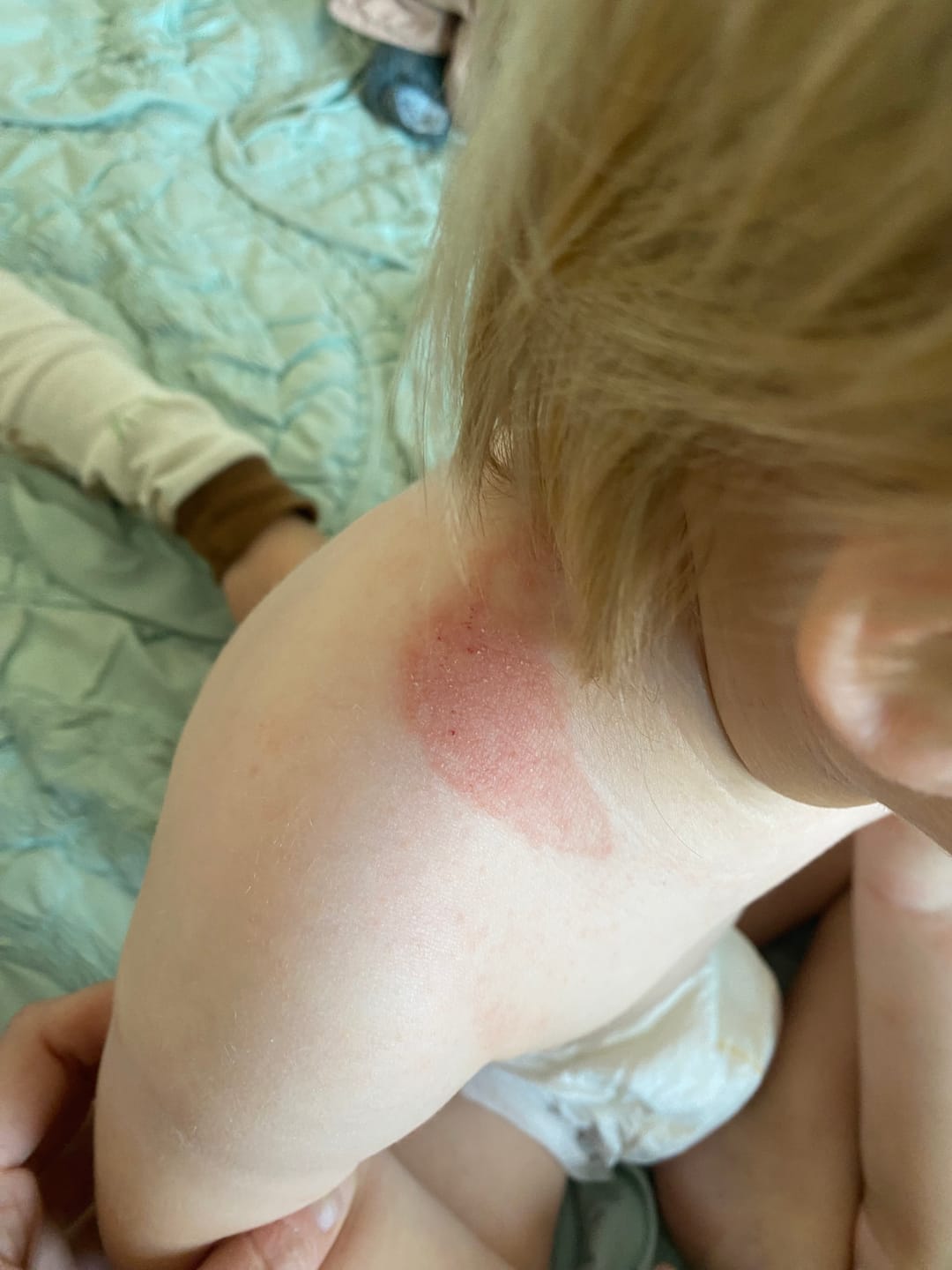 Customer photo review of Relieve Healing Gel