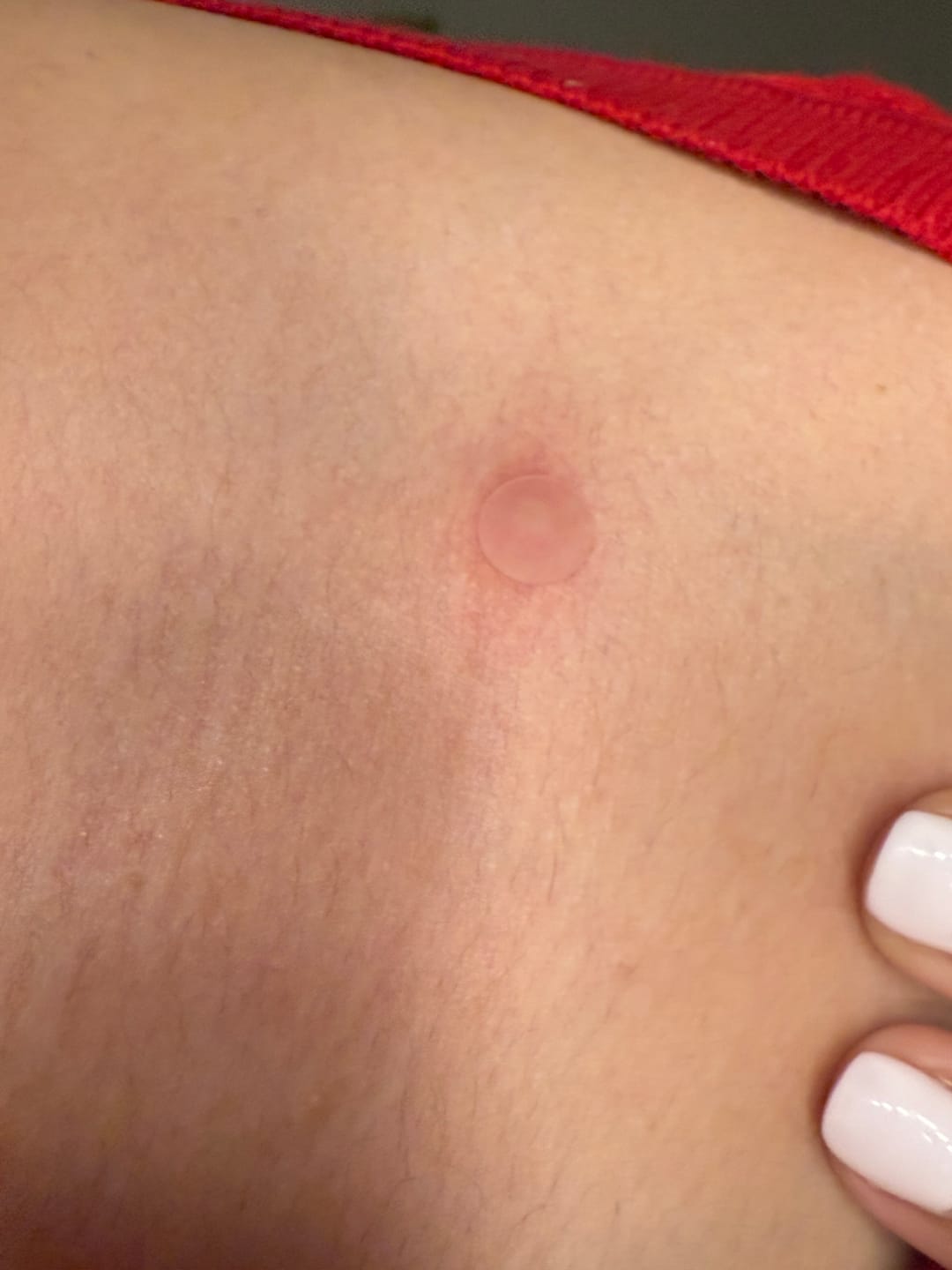 Customer photo review of Brave skin - Day and Night Acne Patches