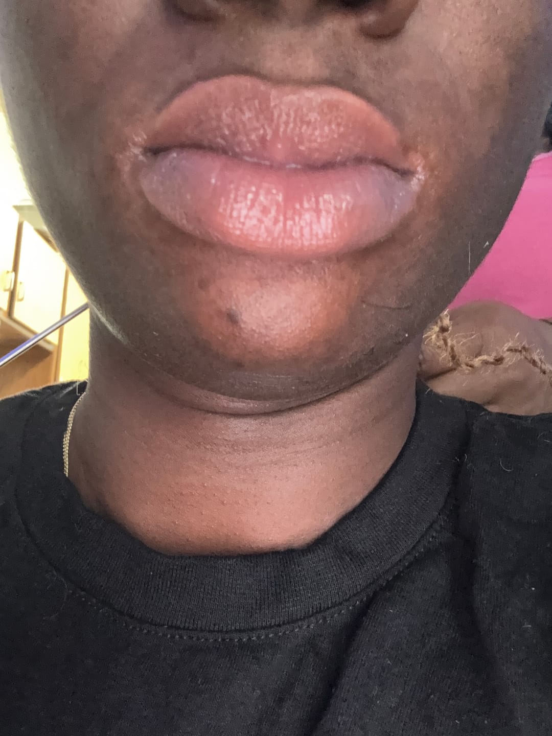 Customer photo review of Lips Lightening Cream For Men and Women (Results in 5 Days or Less)