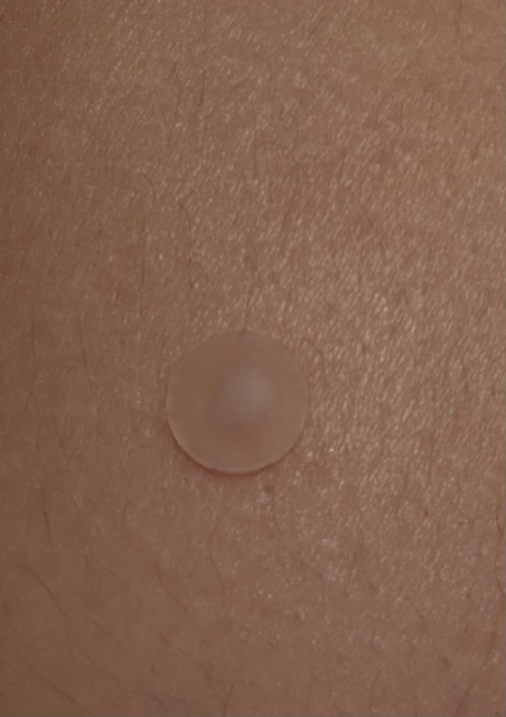 Customer photo review of Brave skin - Day and Night Acne Patches
