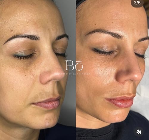Customer photo review of Sérum de Exosomas Ultra Rejuvenecedor con Bioexosomas de Bakuchiol