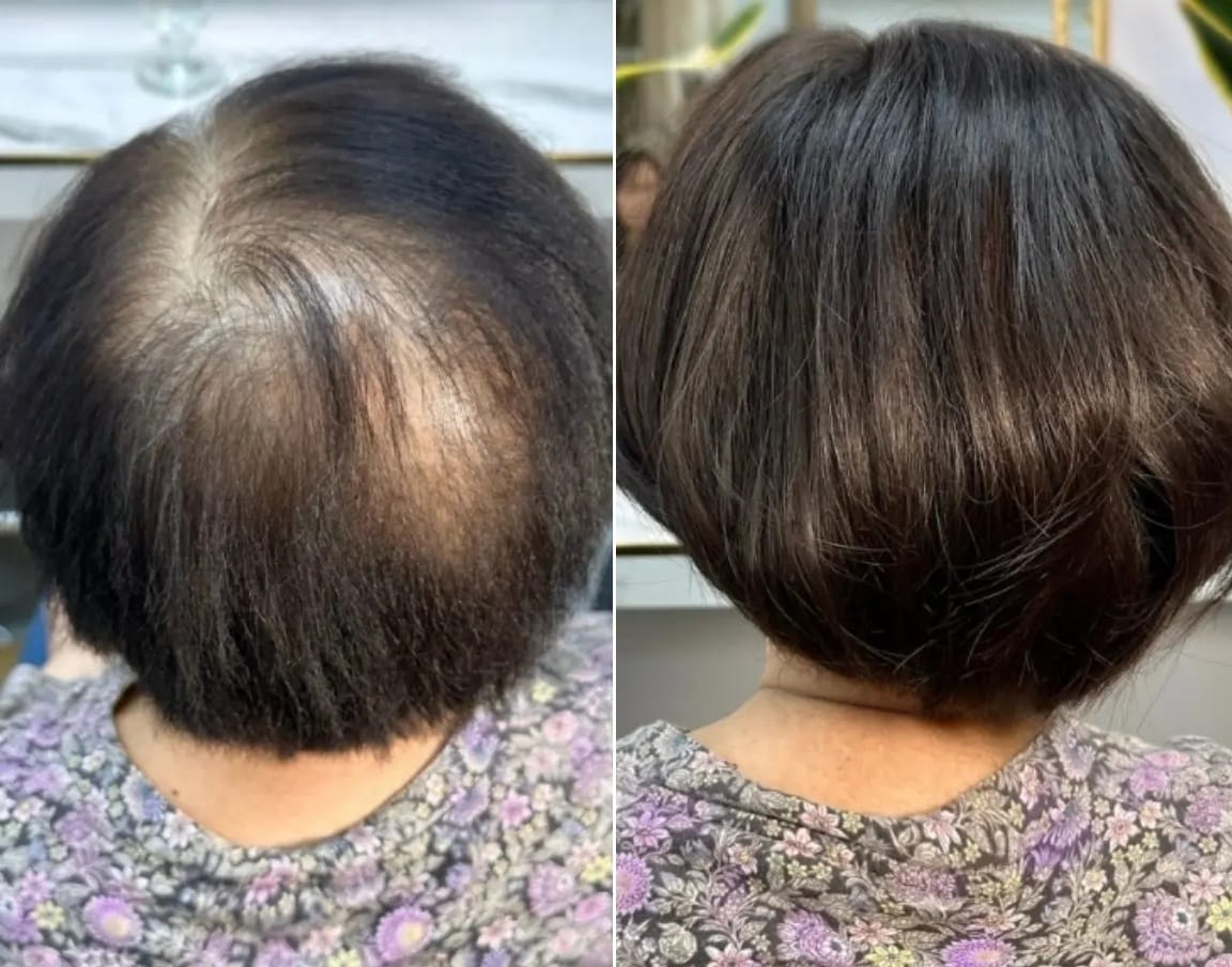 Customer photo review of Breathable&comfortable Short Hair Topper For Thinning Hair