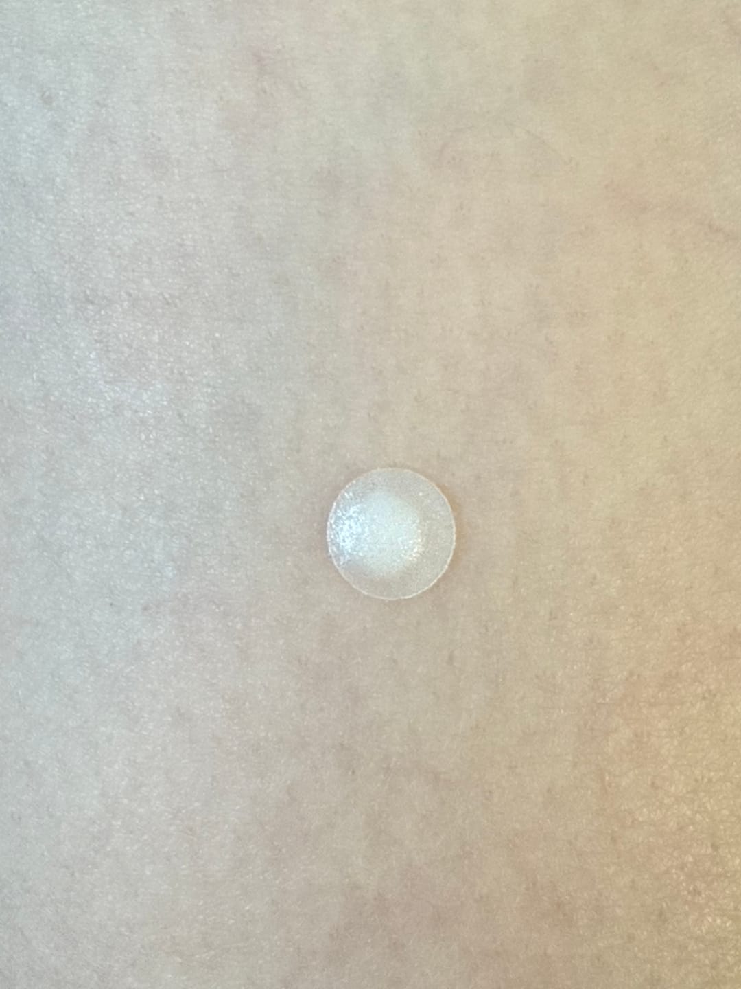 Customer photo review of Brave skin - Day and Night Acne Patches