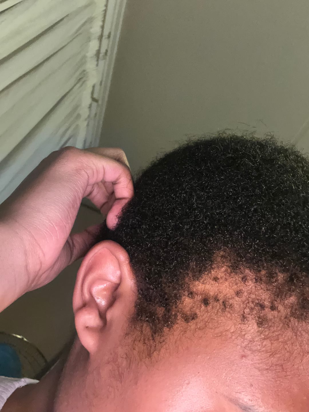 Customer photo review of Hairline Fortifying Serum 30ml - Minoxidil