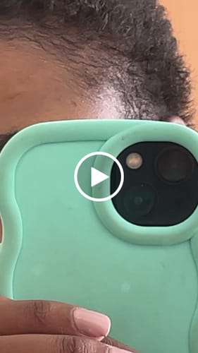 Customer video review of Scalp Serum Set - Minoxidil