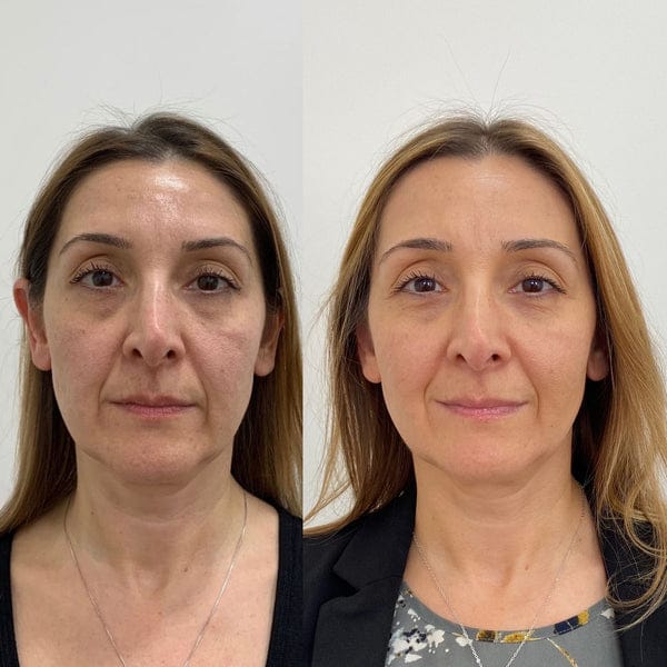Customer photo review of Crema Anti-ojeras Dr Retinol. Elimina tus ojeras en 7 días
