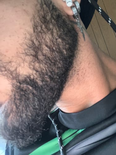 Customer photo review of Minoxidil High Strength (5%) SOLUTION, 3x60ml pack