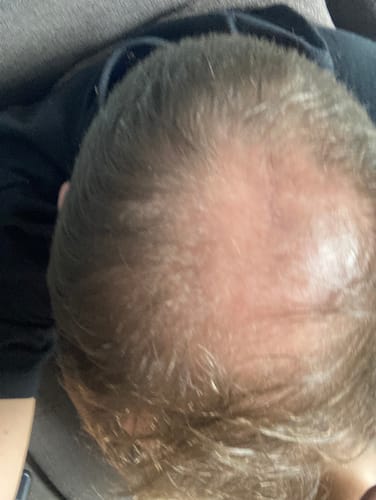 Customer photo review of Minoxidil DOUBLE ACTION FOAM, MEN ONLY 3x60ml Pack