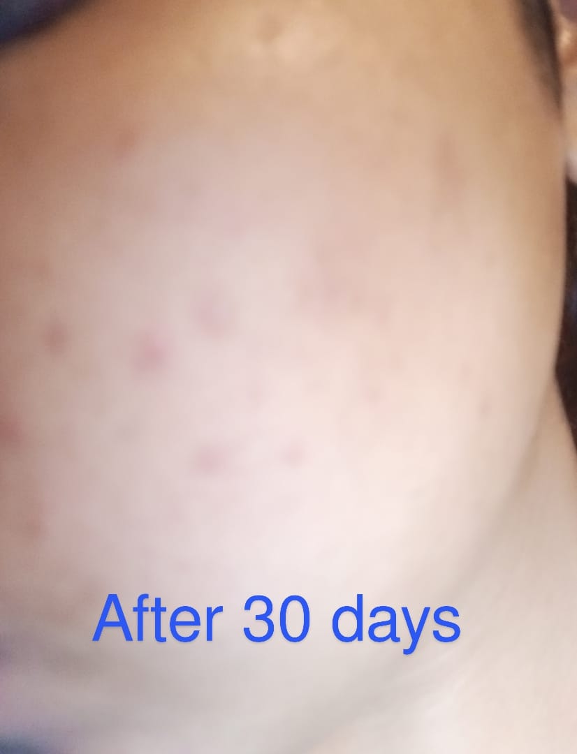 Customer photo review of MandelAC Serum