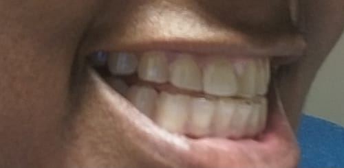 Customer photo review of File Your Smile (A Digital Copy of Your Impressions For Future Replacement Products)