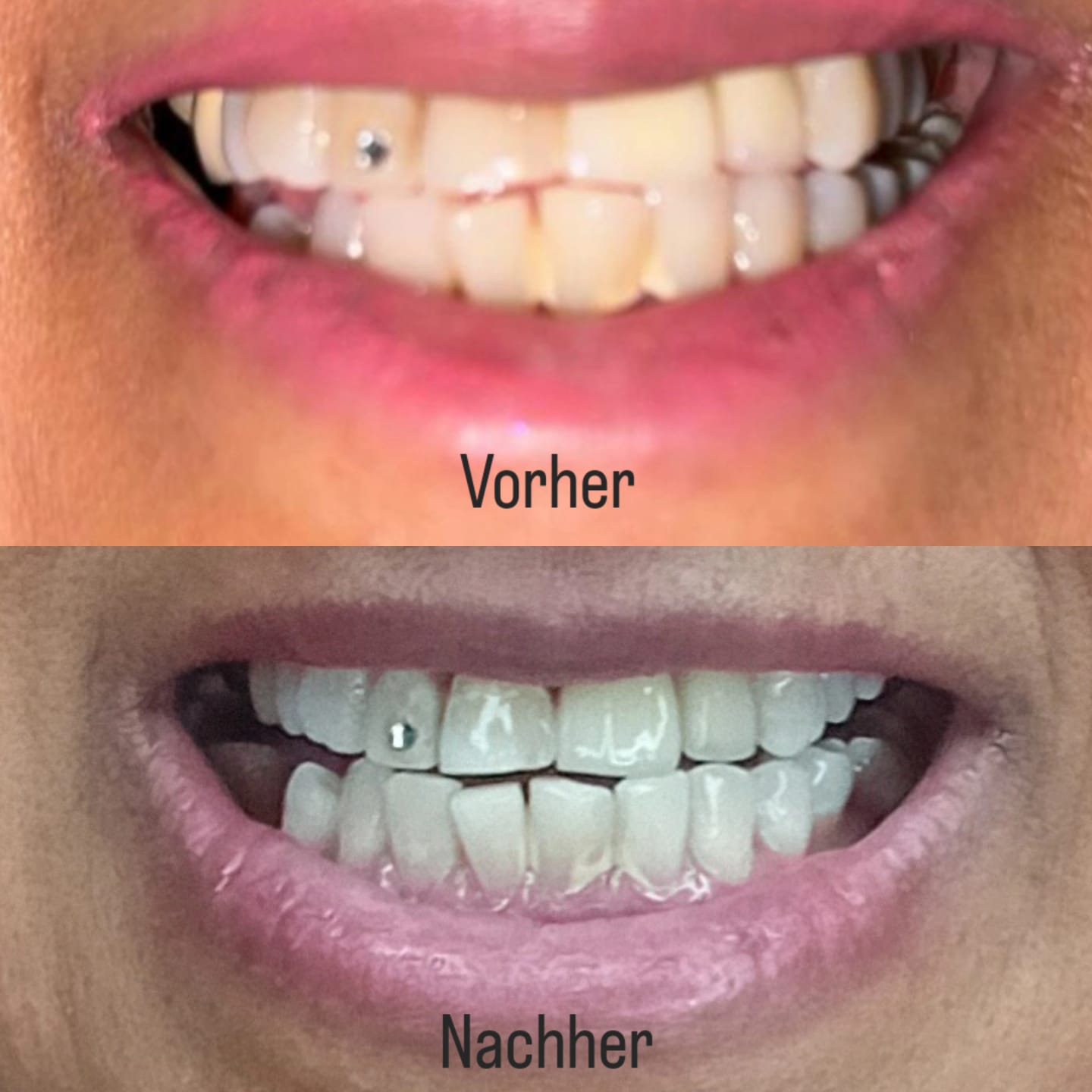 Customer photo review of Zahnbleaching Gel REFILL- 3er Pack - Bleaching Gel - Zahnaufhellung Gel