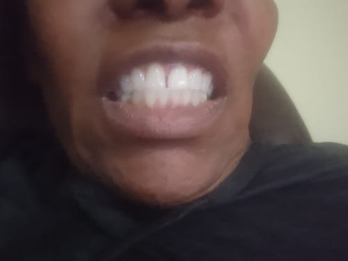 Customer photo review of Prostrips Teeth Whitening Strips