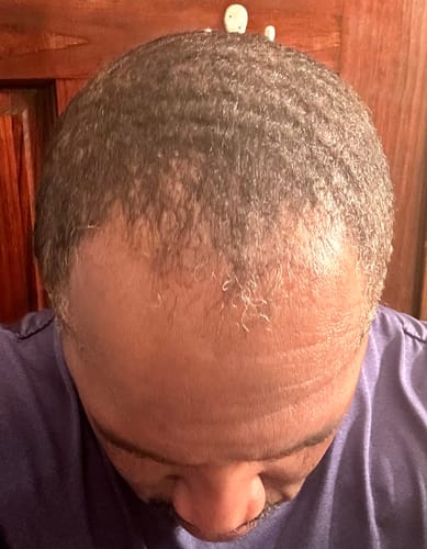 Customer photo review of Rennora Hair Growth Serum