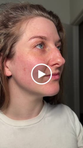 Customer video review of 12-pin Microneedle Cartridges for Dr. Pen M8S (10 Pack)