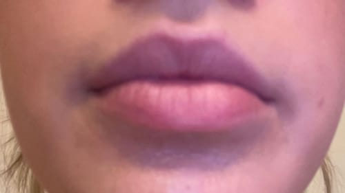 Customer photo review of COSTIQ® EXTREME LIP PLUMPER