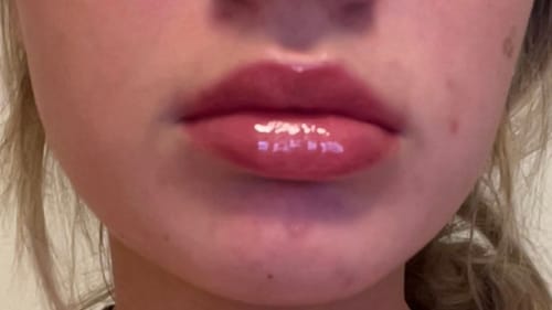 Customer photo review of COSTIQ® EXTREME LIP PLUMPER