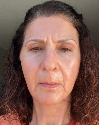 Customer photo review of EvenSkyn® Lumo⁺: Premium Anti-Aging & Skin Tightening Handset (2025)