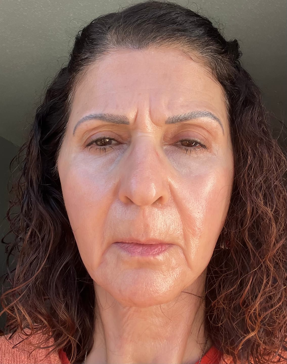 Customer photo review of EvenSkyn® Lumo⁺ Skin Tightening Handset