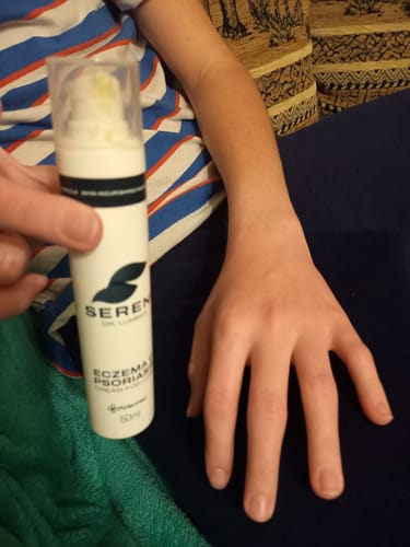 Customer photo review of SERENI Pikkelysömör és Ekcéma Krém