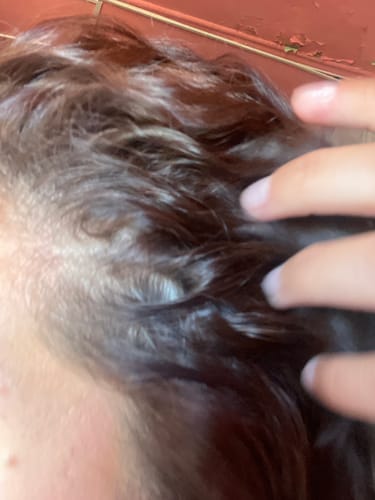 Customer photo review of Shampoo Anticaspa Seca o Psoriasis en Barra