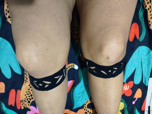 Customer photo review of Easy Kinesiology Tape (30-Day Supply)