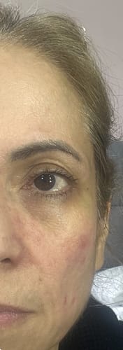 Customer photo review of Skin Fit Topical Filler Collagen/Volumizing Ampoule