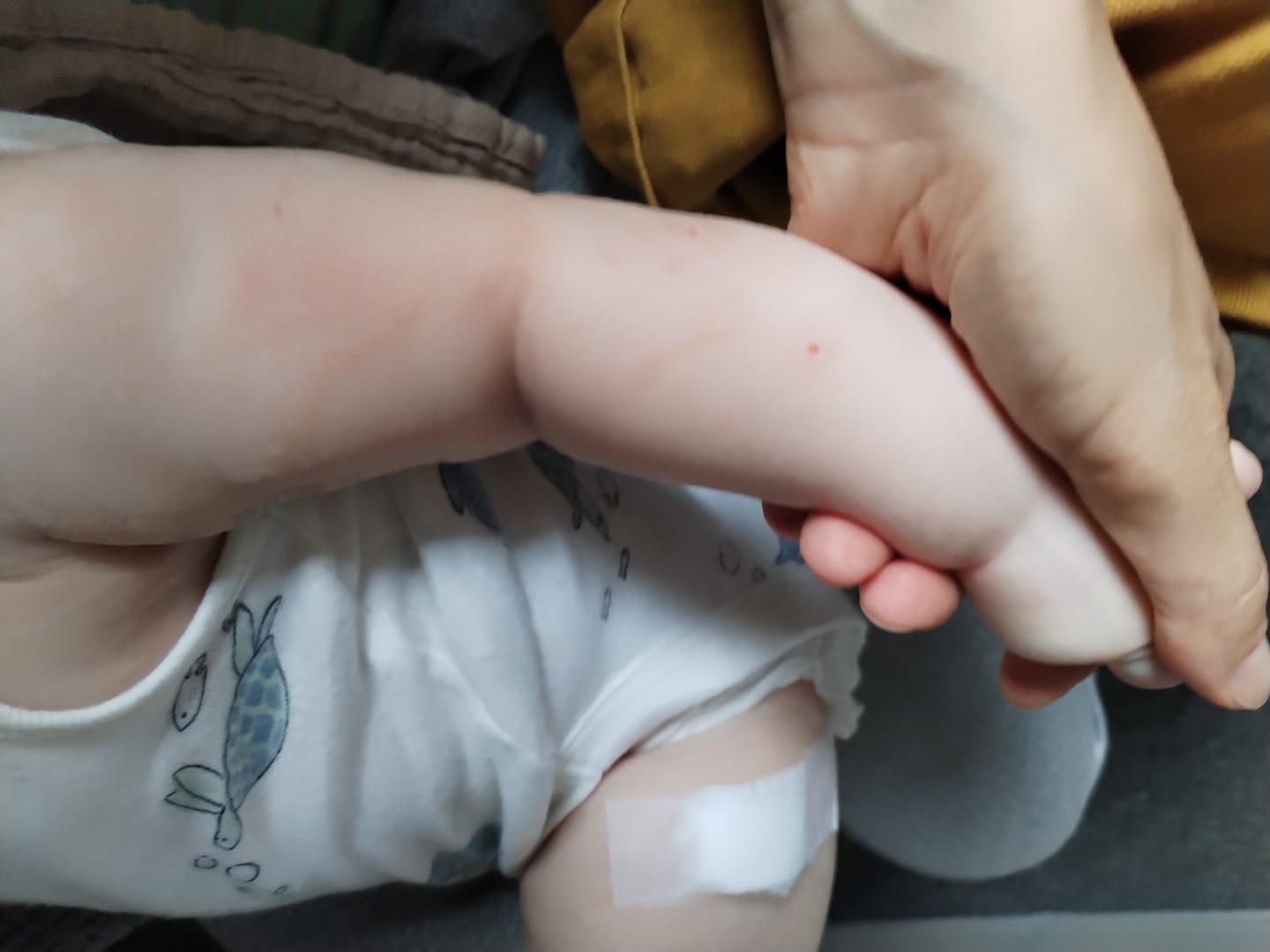 Customer photo review of Bioskin Junior Outbreak Rescue Cream