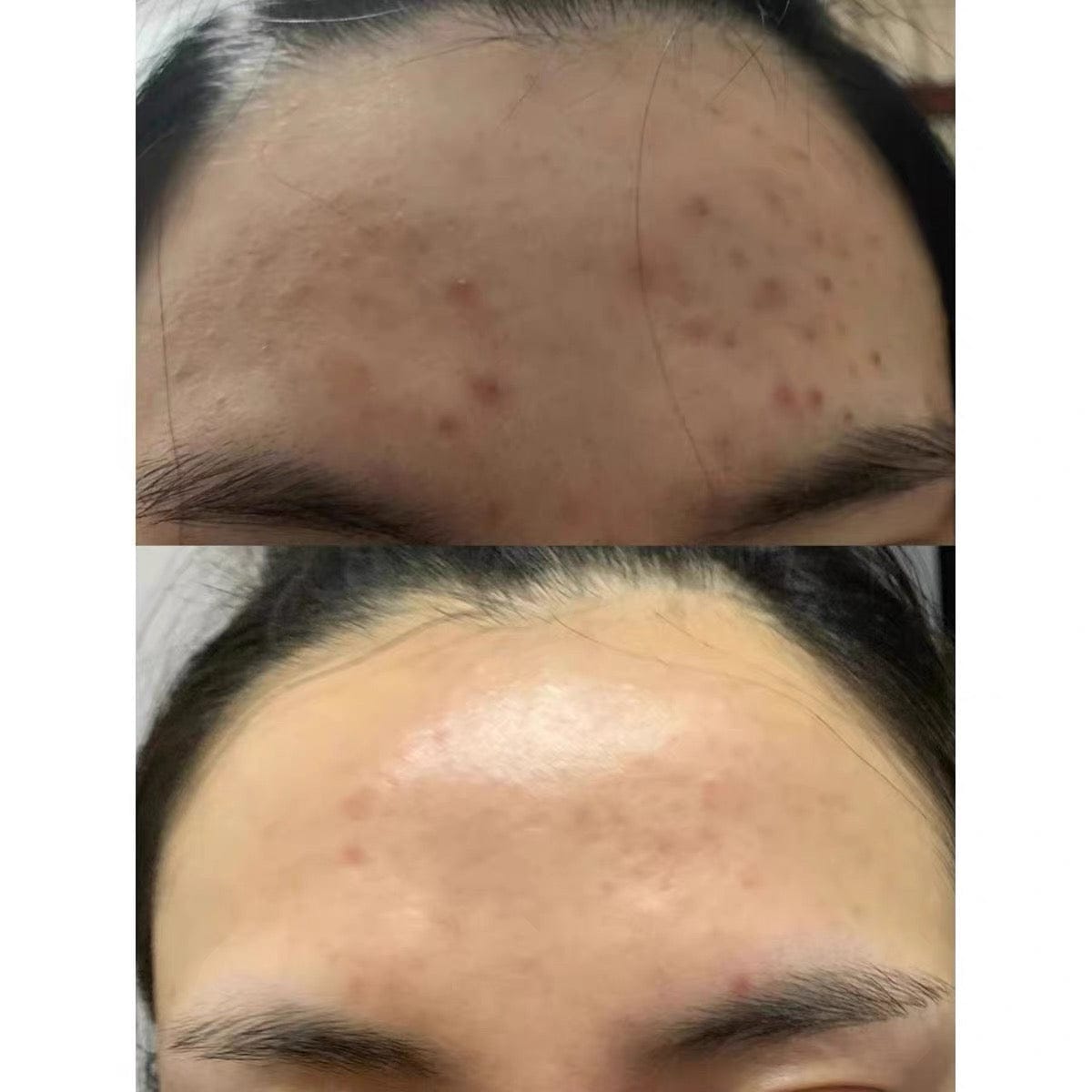 Customer photo review of LED Face Mask (Skin Photon Therapy)