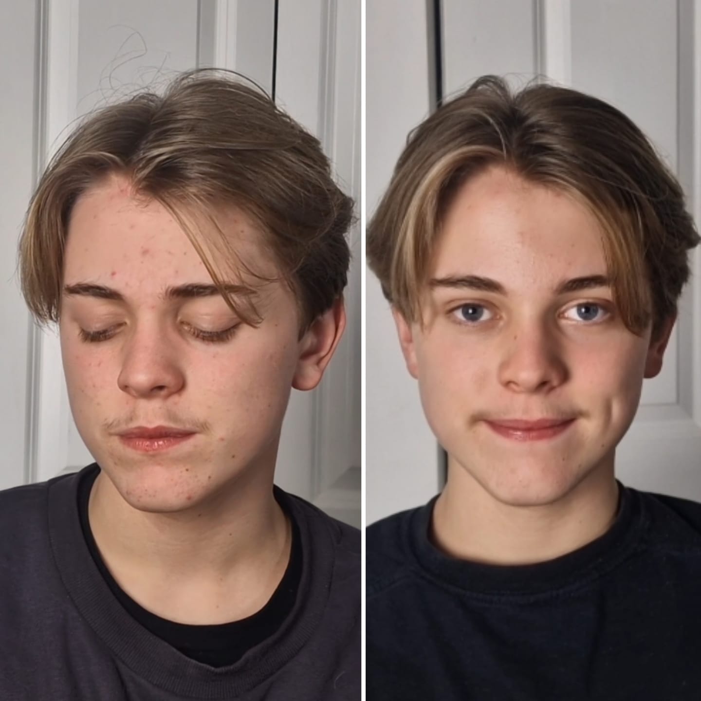 Customer photo review of Antiac Acne Rescue Pack