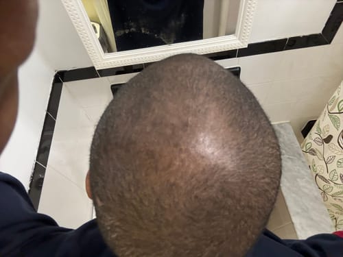 Customer photo review of Rennora EXTRA-Strength Hair Growth Serum