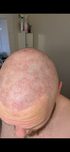 Customer photo review of Seb Natural Calming Serum