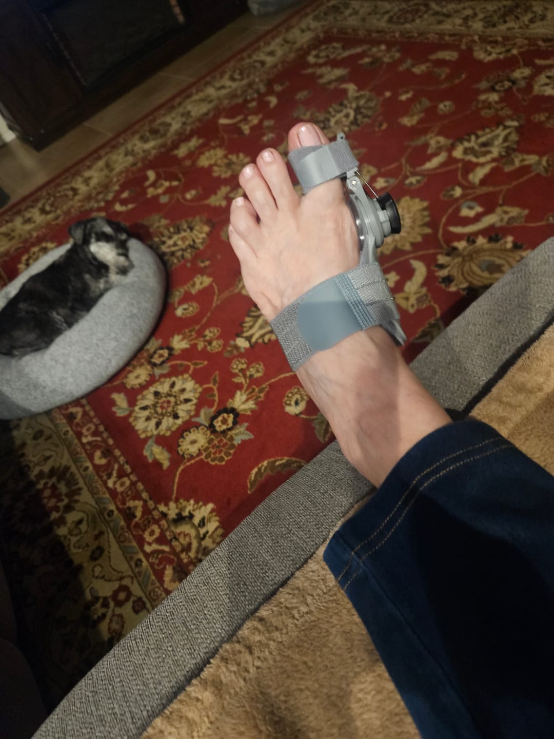 Customer photo review of Treatmedy™ Bunion Fix
