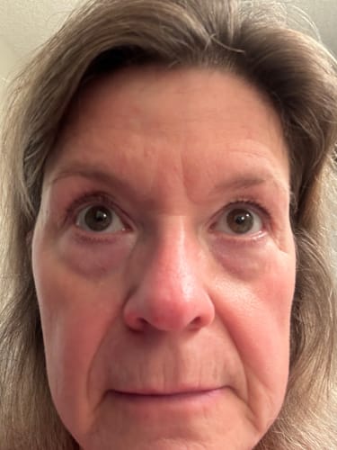 Customer photo review of F-Balm - Premium Anti-aging Tallow Balm - 2 oz.