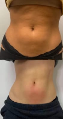 Customer photo review of CelluLuxe Pro - Straffe deinen Körper in nur 10 Minuten täglich ganz bequem von zu Hause.