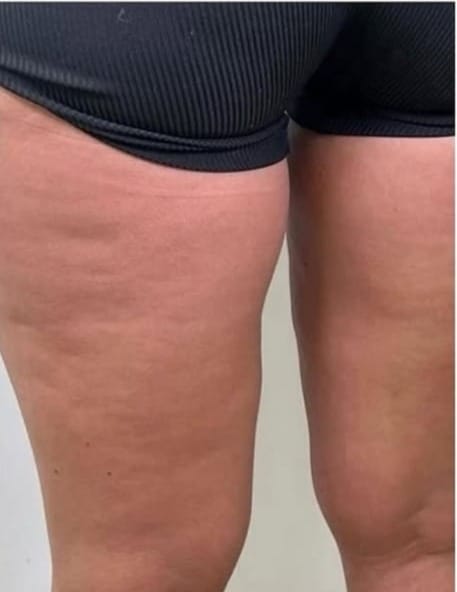 Customer photo review of CelluLuxe Pro - Straffe deinen Körper in nur 10 Minuten täglich ganz bequem von zu Hause.