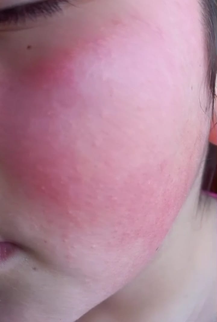 Customer photo review of Delicate Touch - Emulsión Recuperadora | Para pieles con dermatitis, rosácea o sensibilidad