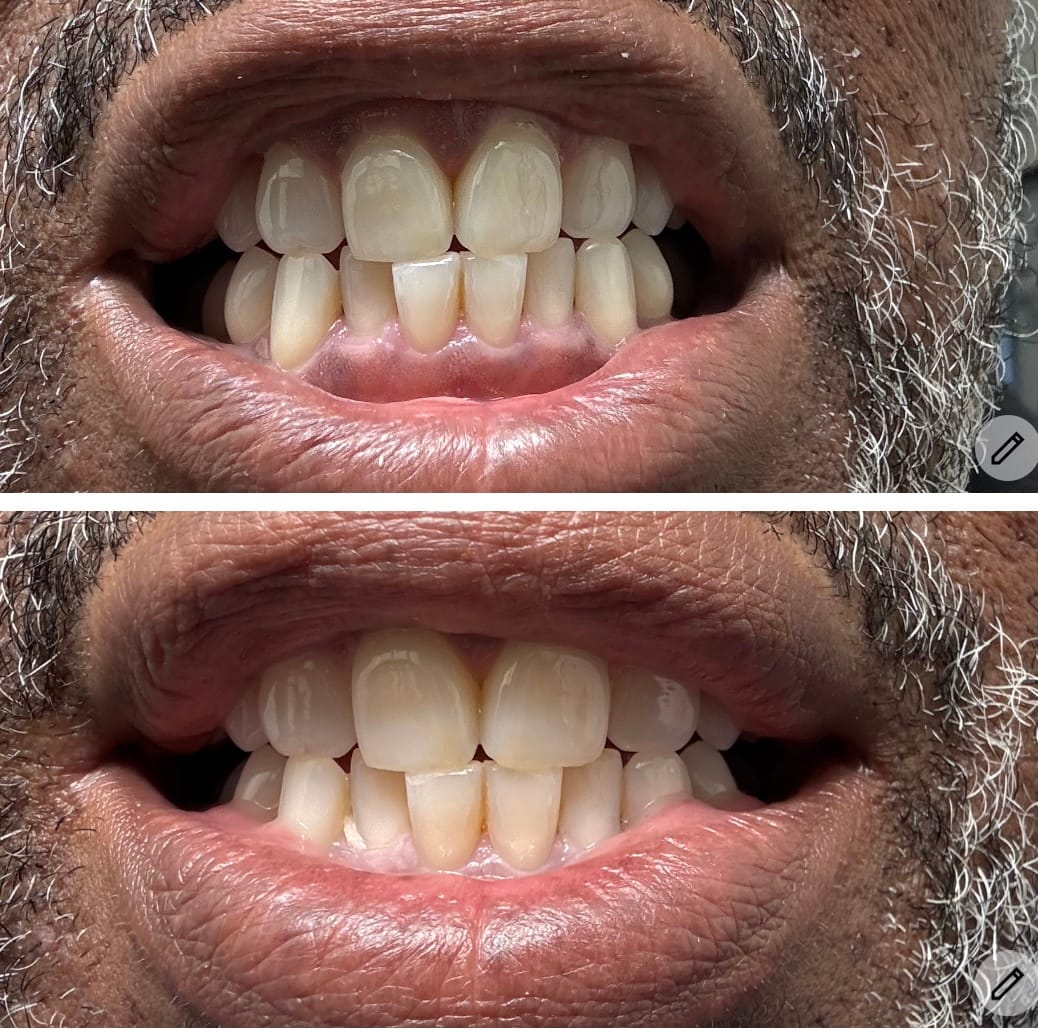 Customer photo review of LIVFRESH Wintergreen - 3 Pack
