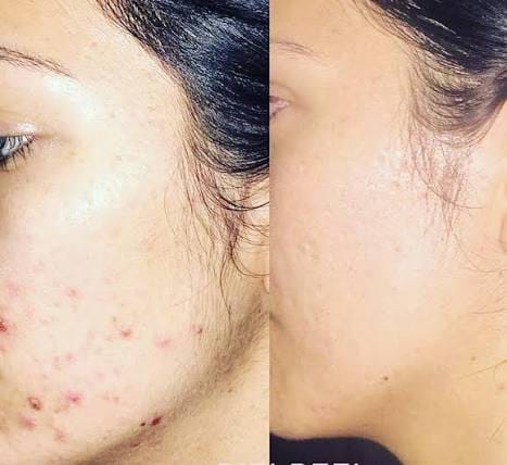Customer photo review of Kill Acne & Redness Ritual