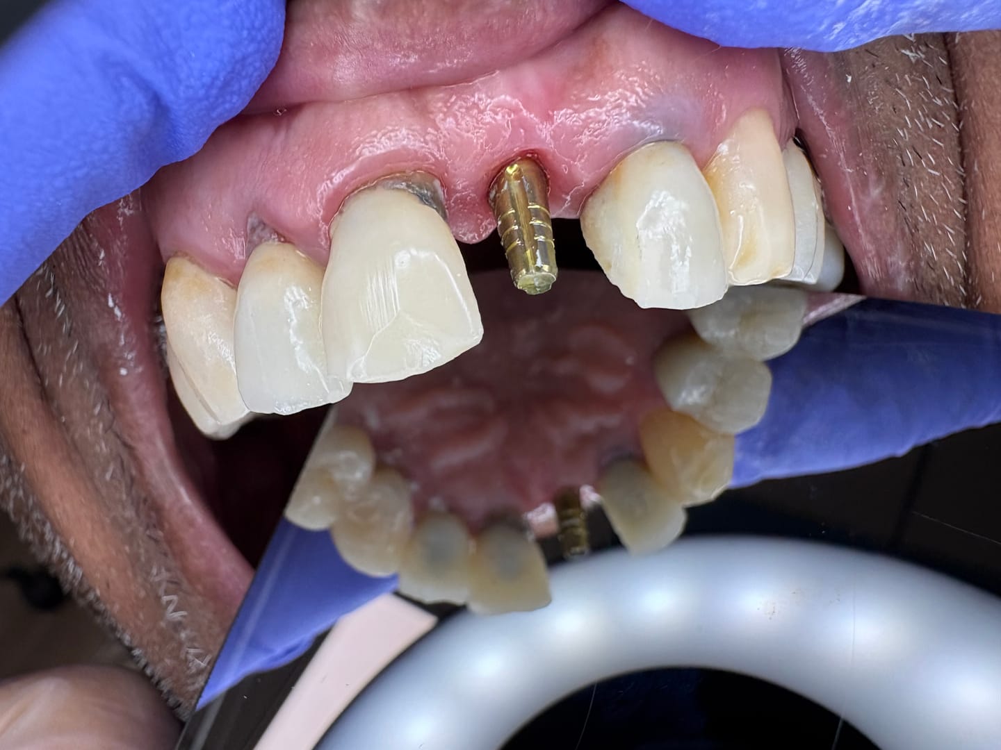Customer photo review of ALTO® One-Piece Dental Implant Ø3.5 - Monoblock System