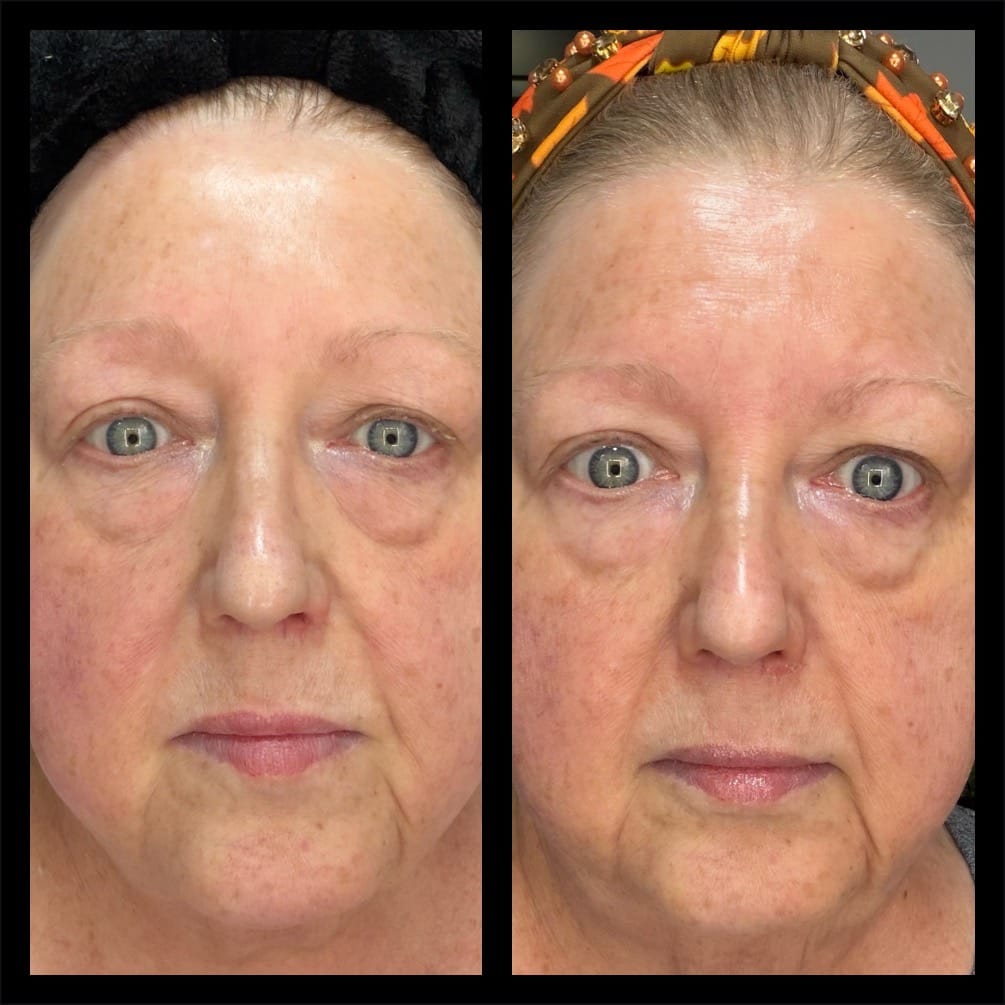 Customer photo review of HEDO Signature Peel with Care Kit