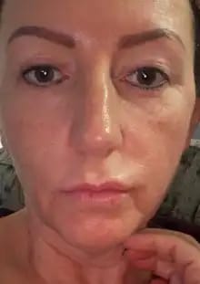 Customer photo review of Sistema de Microinfusão™ + Soro Bónus