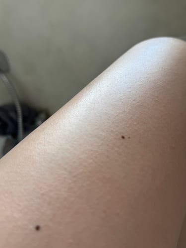 Customer photo review of Ingrown SOS