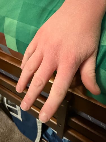 Customer photo review of Soothe Stick Skin Balm Stick for Eczema and Dry, Cracked Skin, Soothing effect for itch and irritation