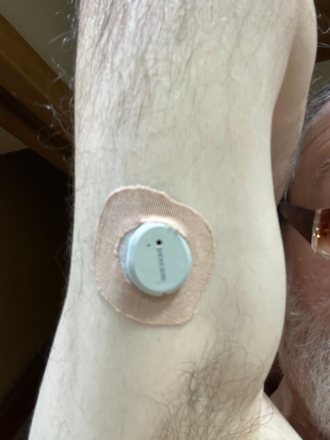 Customer photo review of Skin Grip Original - Dexcom G7 & Stelo Adhesive Patches (With Cutout)