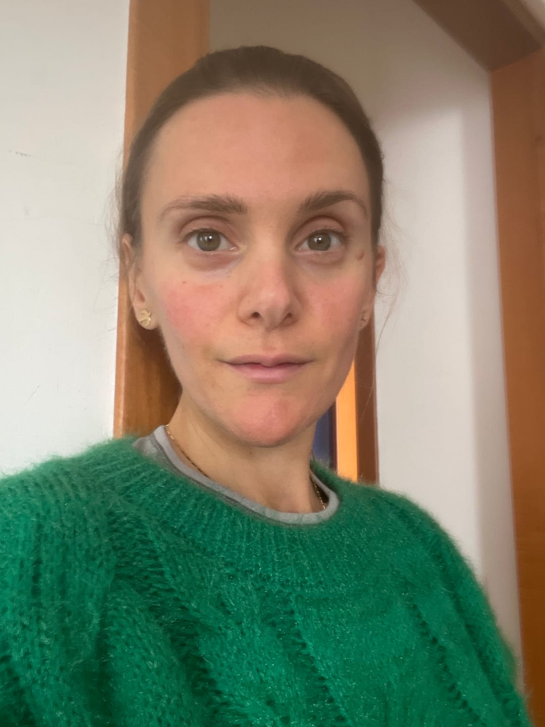 Customer photo review of Instant Rosacea, Acne & Redness Stopper