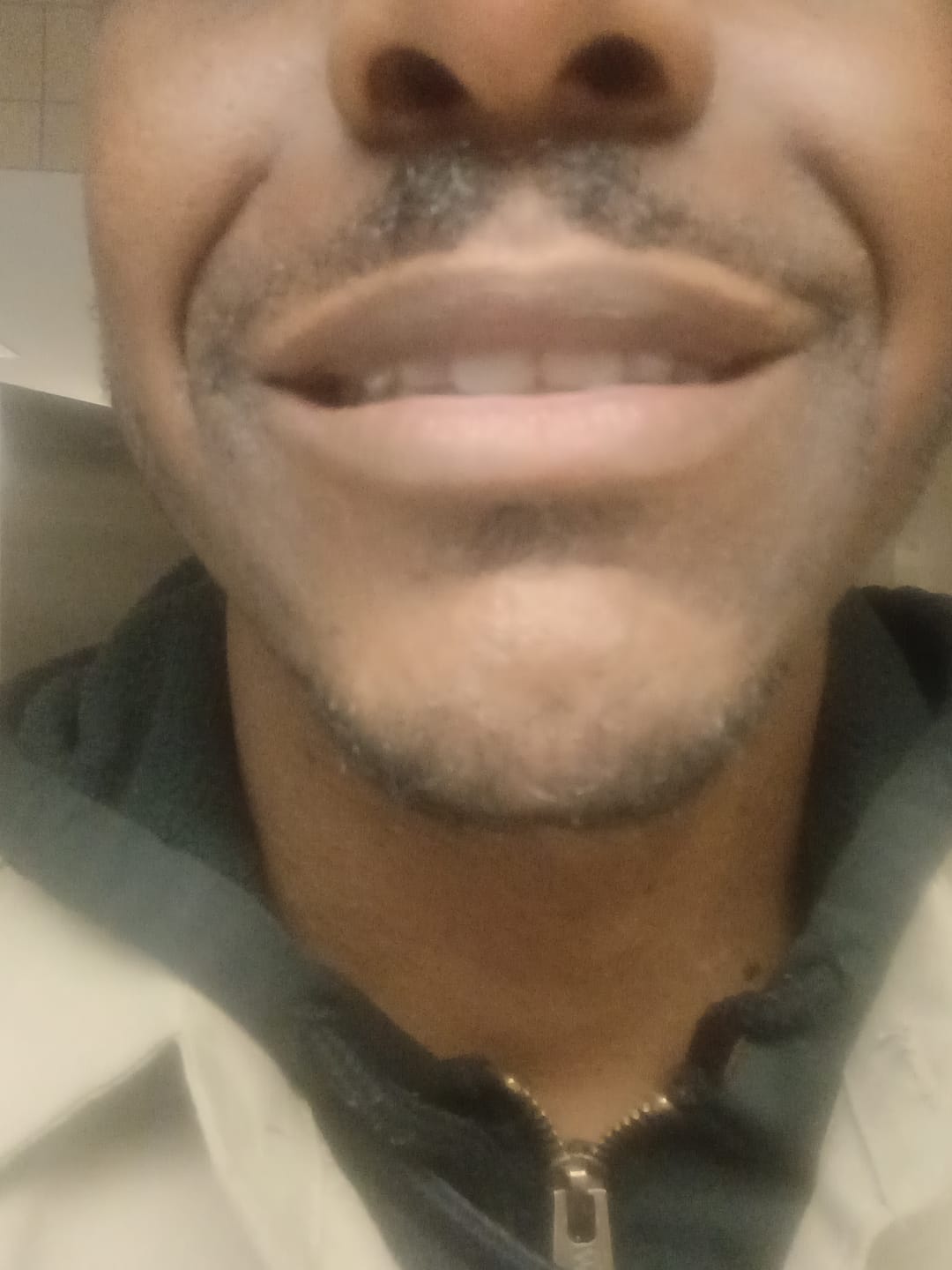 Customer photo review of Lips Lightening Cream For Men and Women (Results in 5 Days or Less)