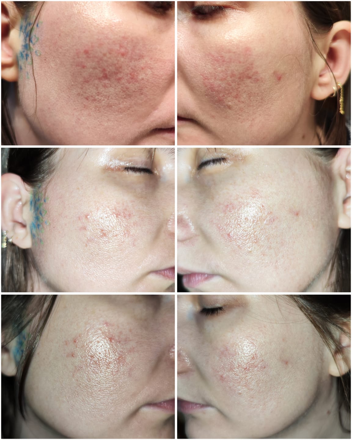 Customer photo review of Acne Care Phage Gel
