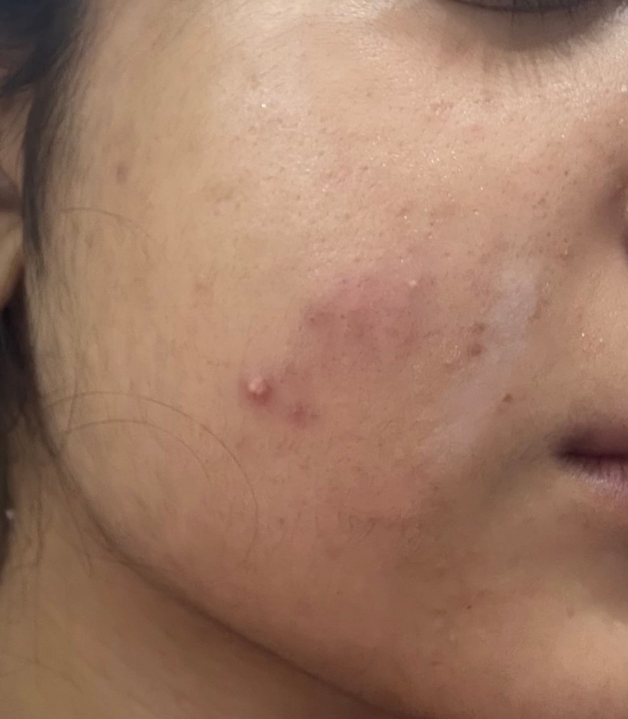 Customer photo review of NiaRonic Serum (Pore Minimizing)