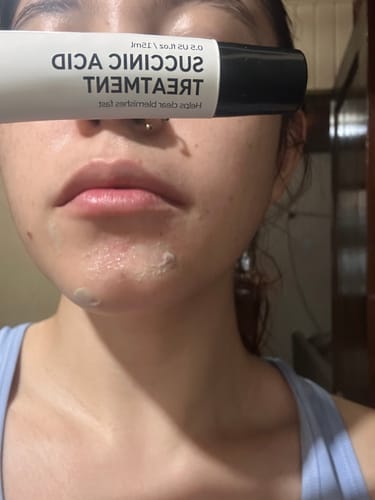 Customer photo review of Succinic Acid Acne Treatment