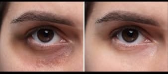 Customer photo review of Eye Roller | Eliminates Dark Circles & Puffy Eyes